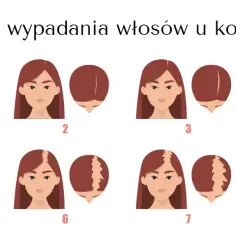 Łysienie androgenowe u kobiet: objawy, przyczyny i wpływ